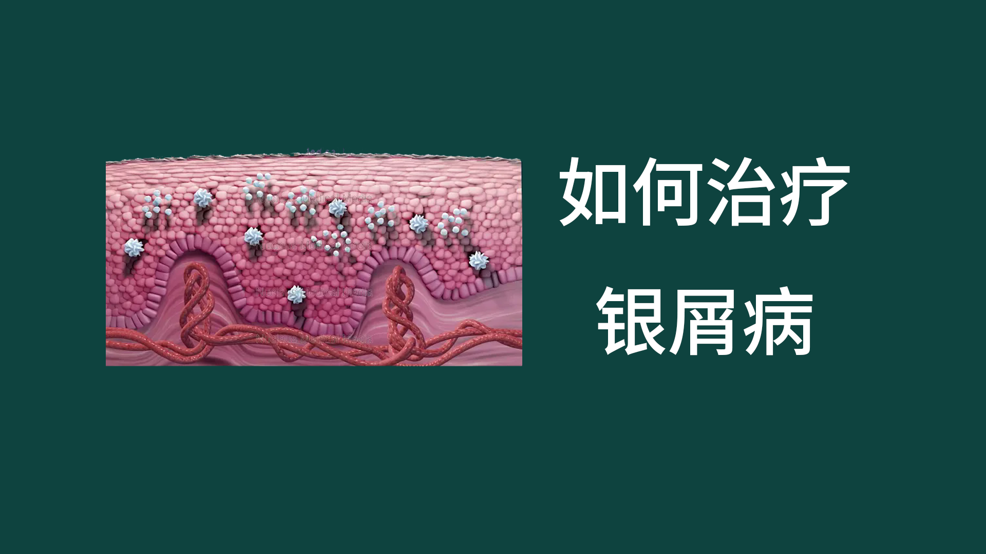 銀屑病