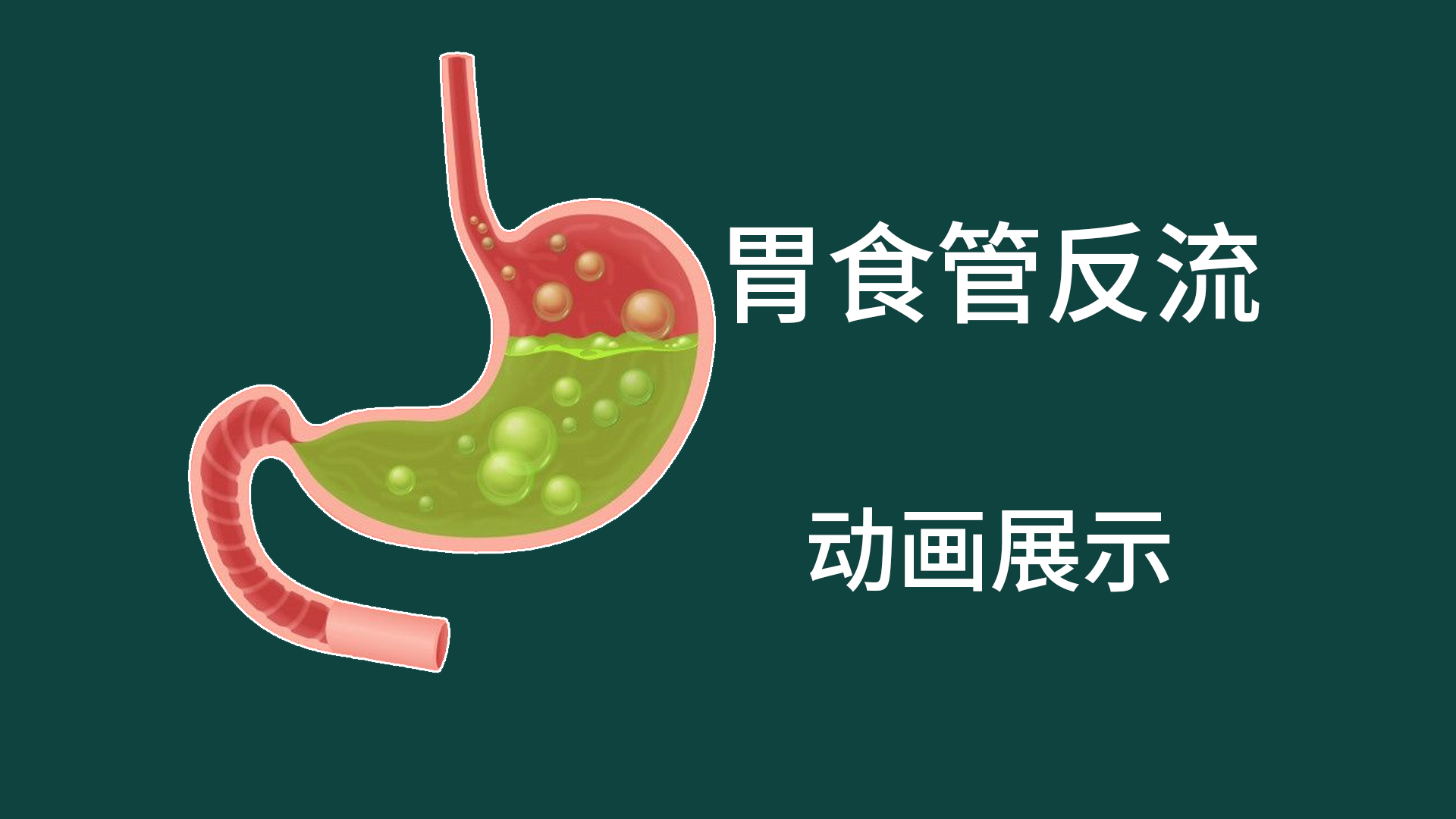 胃食管反流