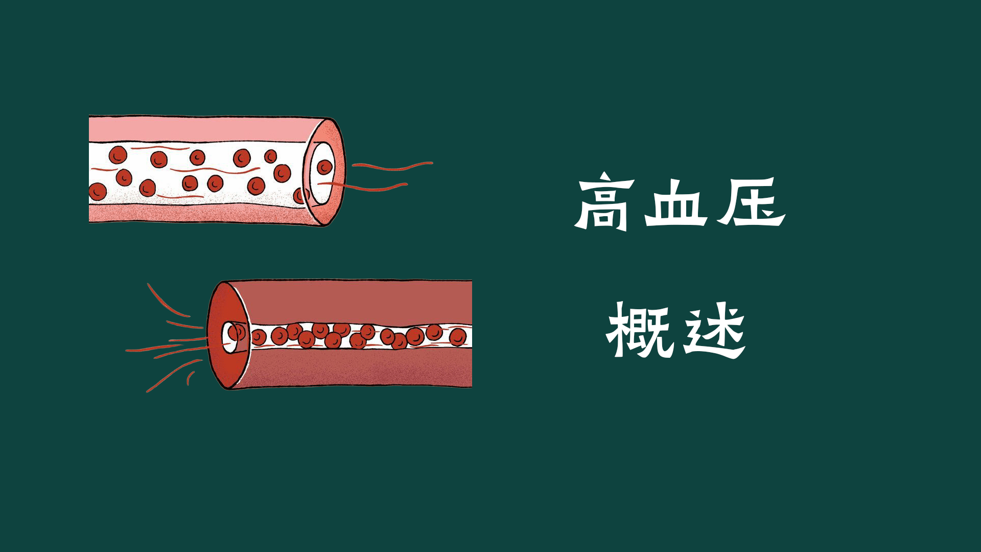高血壓