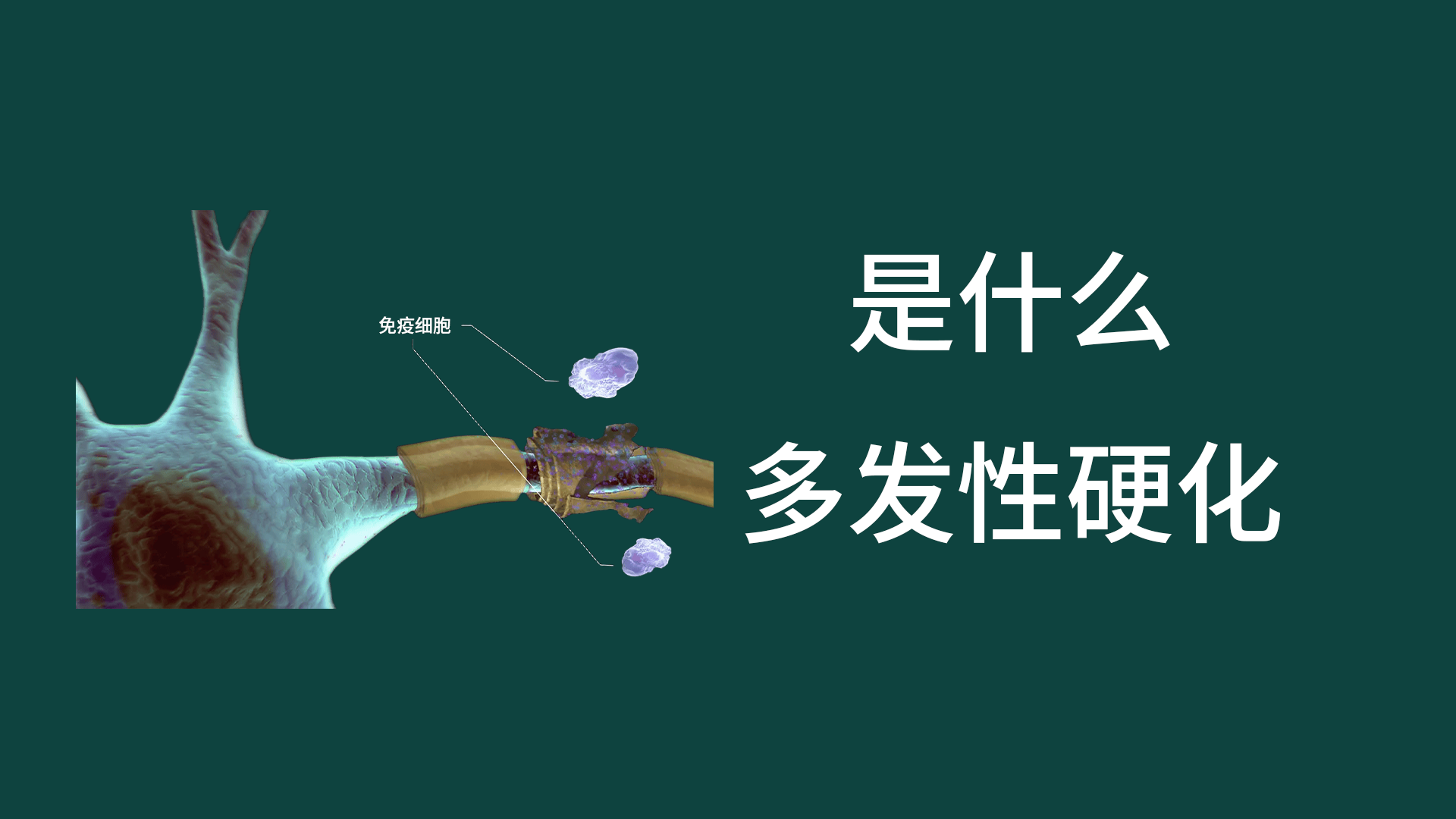 多發性硬化癥