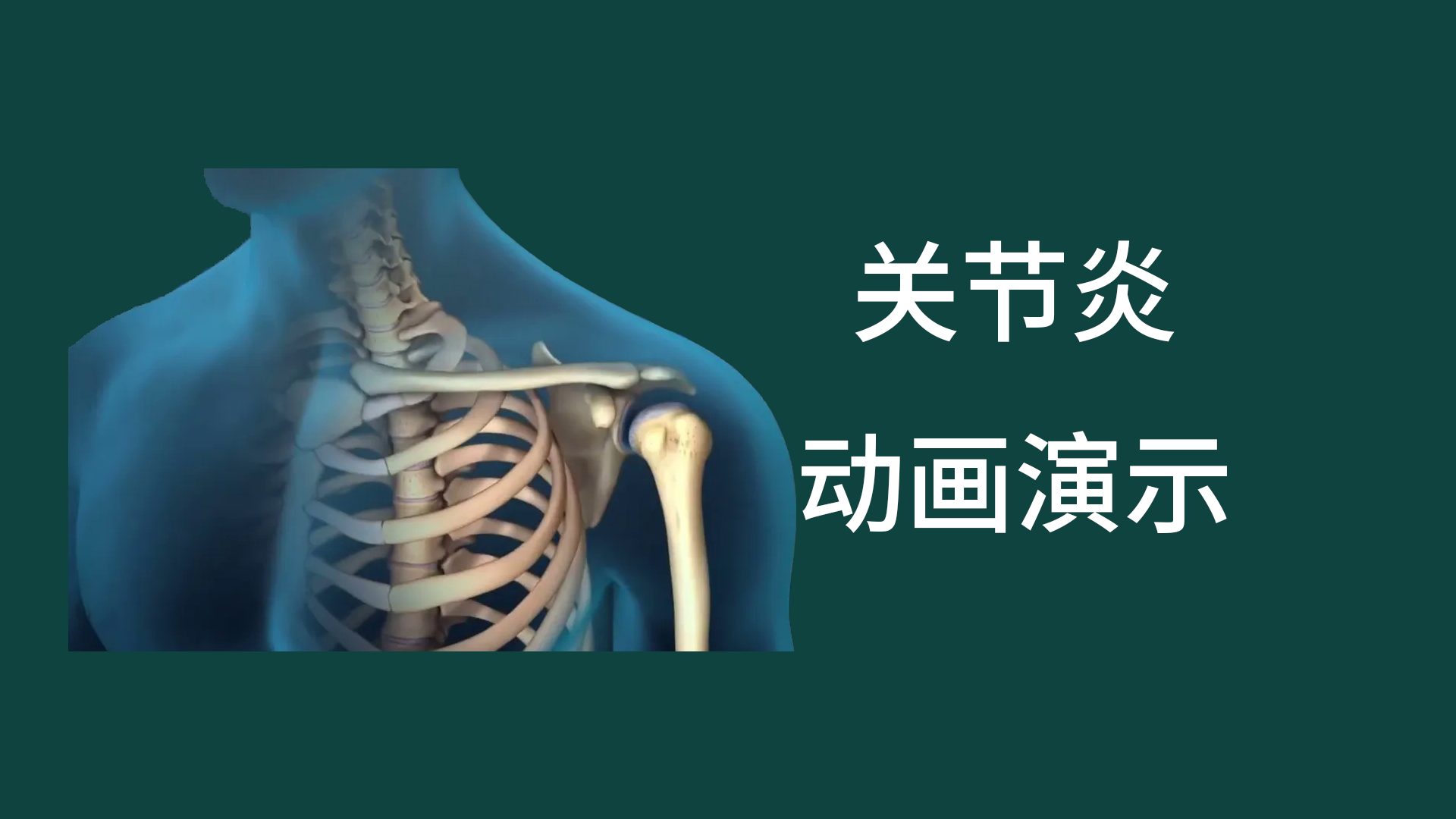 肩周炎