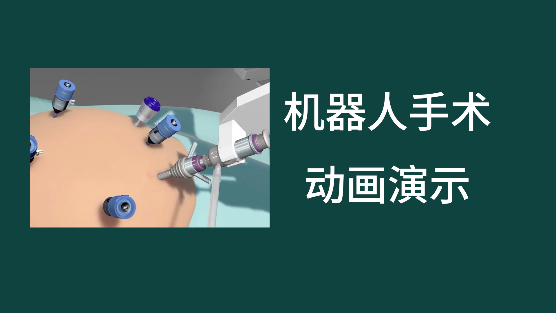 機器人減肥手術