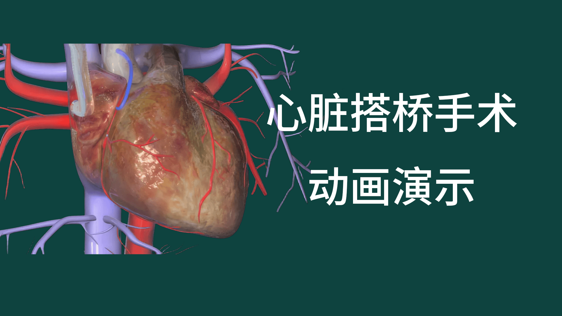 心臟搭橋手術(shù)