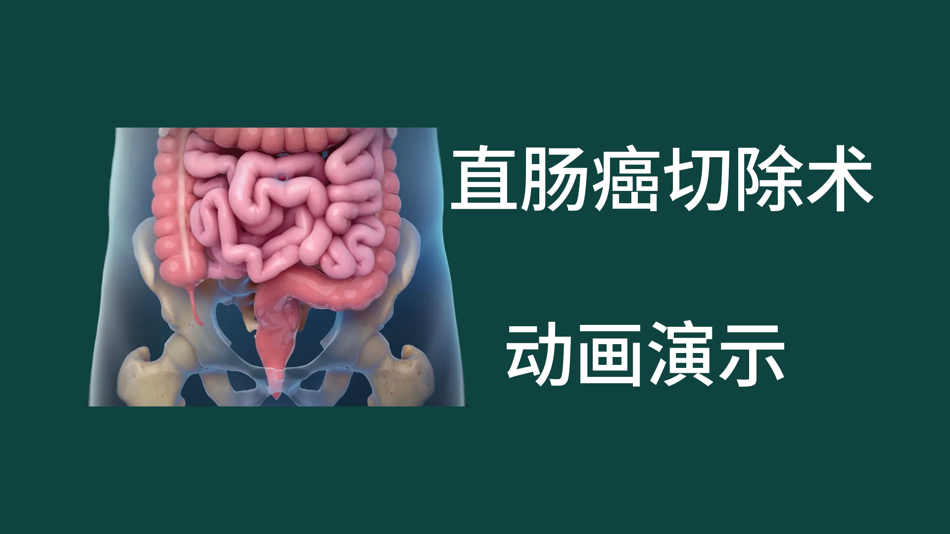 直腸癌切除術