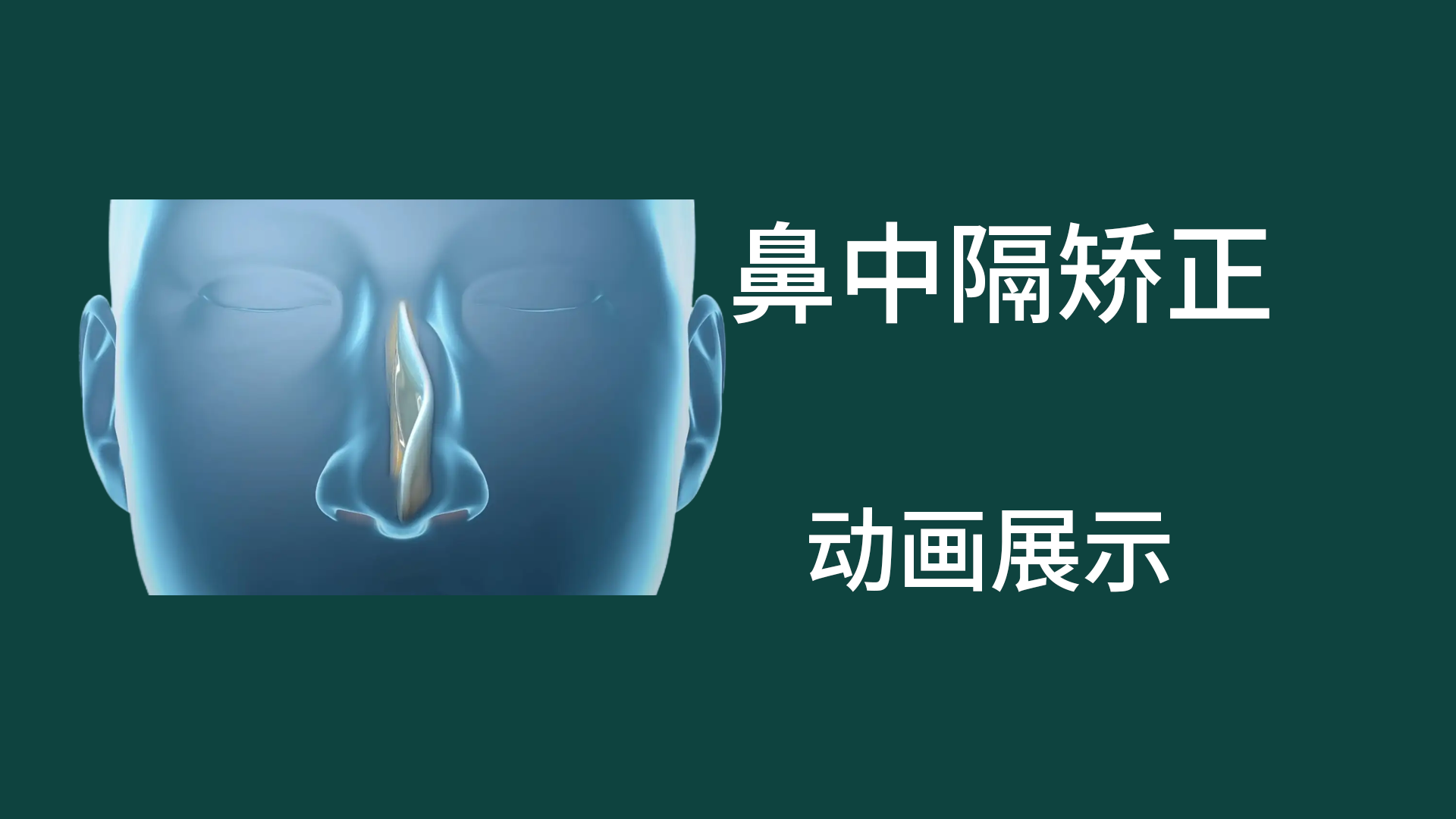 鼻中隔偏曲矯正手術(shù)